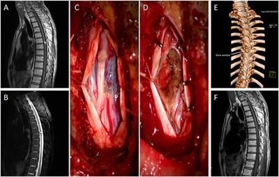 Frontiers Hemilaminectomy for the removal of the spinal tumors